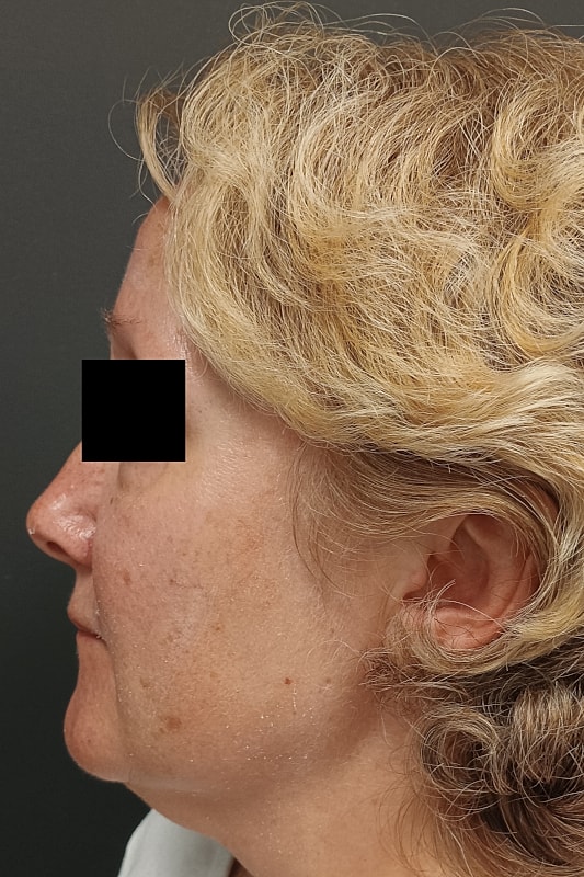 Facelift Patrick Felice Before & After