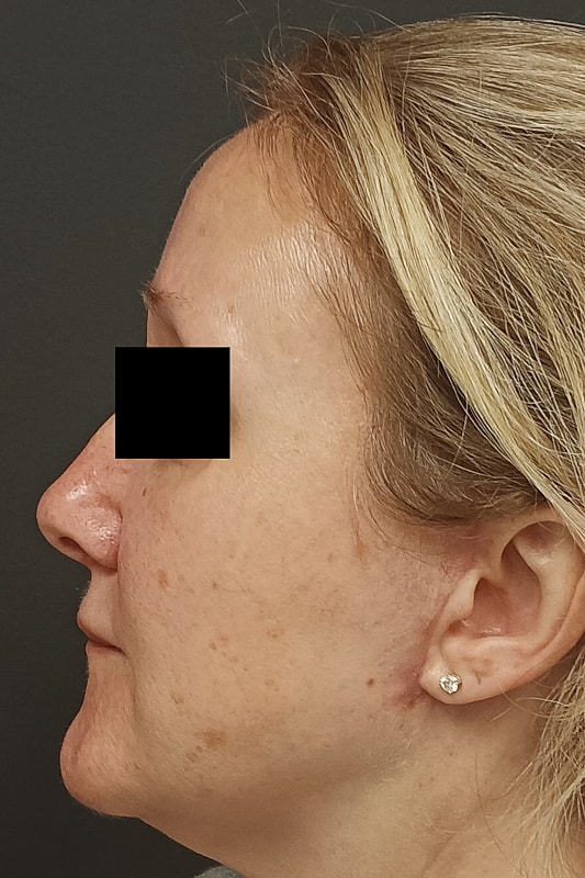 Facelift Patrick Felice Before & After