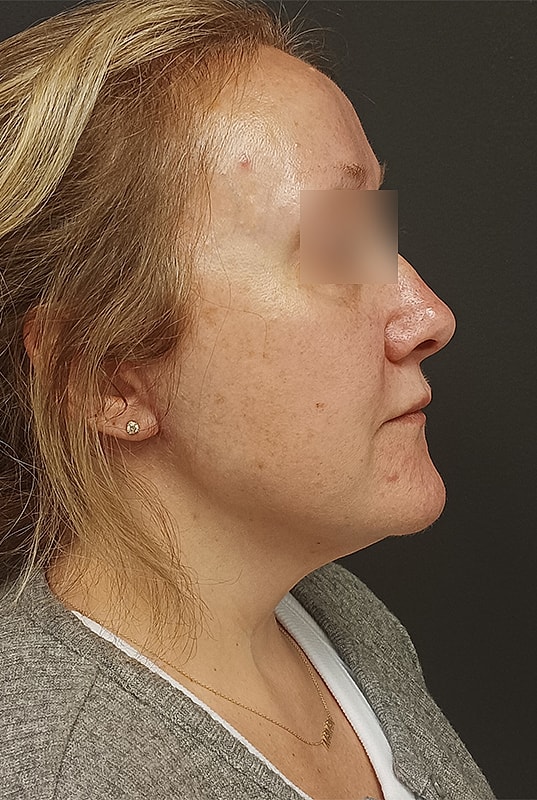 Facelift Patrick Felice Before & After