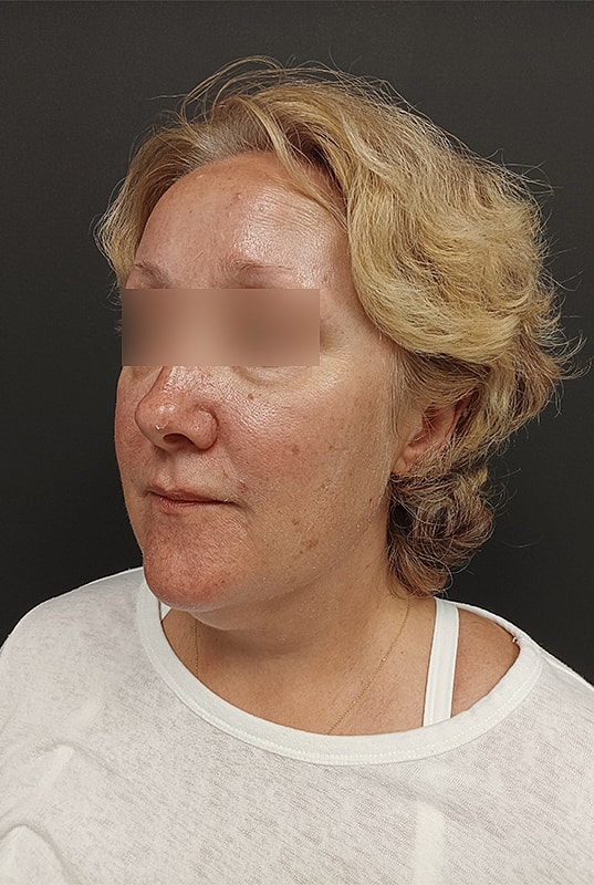 Facelift Patrick Felice Before & After