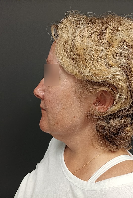 Facelift Patrick Felice Before & After