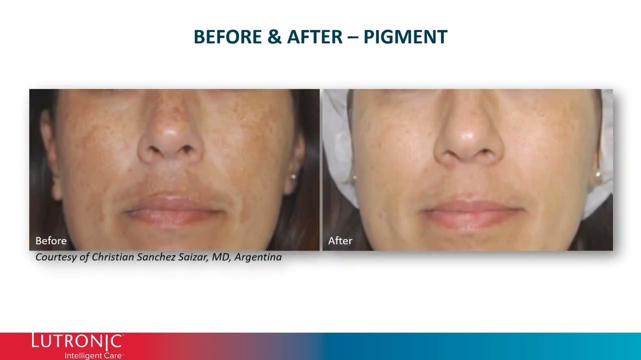 Before and after skin treatment results for pigmentation.